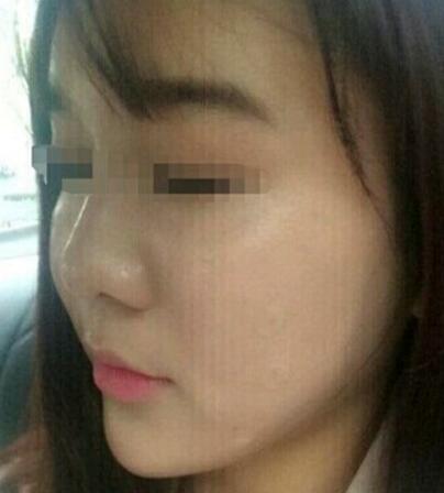 在濟(jì)南吉芙醫(yī)院做的玻尿酸填充淚溝,填充淚溝圖片分享