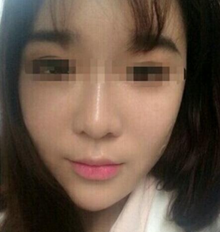 在濟(jì)南吉芙醫(yī)院做的玻尿酸填充淚溝,填充淚溝圖片分享