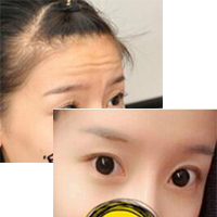 注射瘦臉去抬頭紋果不錯(cuò)——濟(jì)南吉芙美容整形醫(yī)院