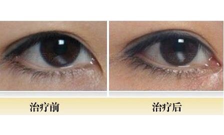 開內(nèi)眼角前后對(duì)比圖，眼睛整形價(jià)格