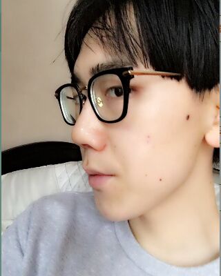 男生隆鼻整形案例分享，福州美貝爾張潮做的