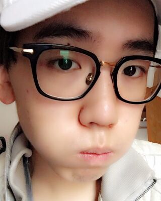 男生隆鼻整形案例分享，福州美貝爾張潮做的