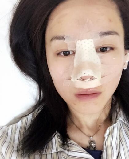 哈爾濱假體隆鼻價(jià)格8900元,隆鼻真實(shí)案例分享