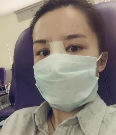哈爾濱假體隆鼻價(jià)格8900元,隆鼻真實(shí)案例分享