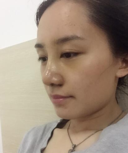 哈爾濱假體隆鼻價(jià)格8900元,隆鼻真實(shí)案例分享