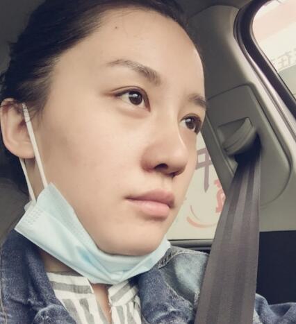 哈爾濱假體隆鼻價(jià)格8900元,隆鼻真實(shí)案例分享