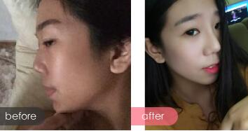 假體隆鼻術(shù)后注意事項(xiàng)和恢復(fù)過(guò)程圖分享