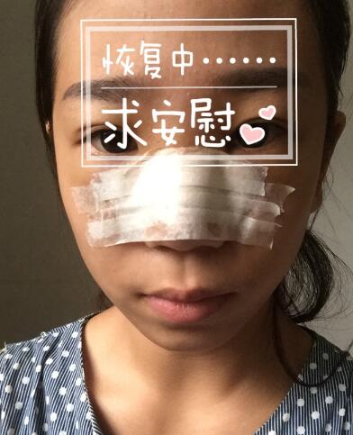 假體隆鼻術(shù)后注意事項(xiàng)和恢復(fù)過(guò)程圖分享