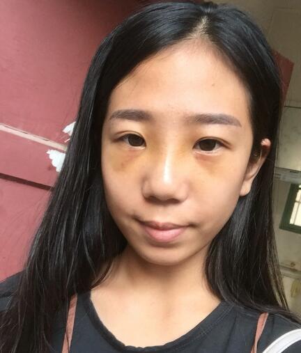 假體隆鼻術(shù)后注意事項(xiàng)和恢復(fù)過(guò)程圖分享