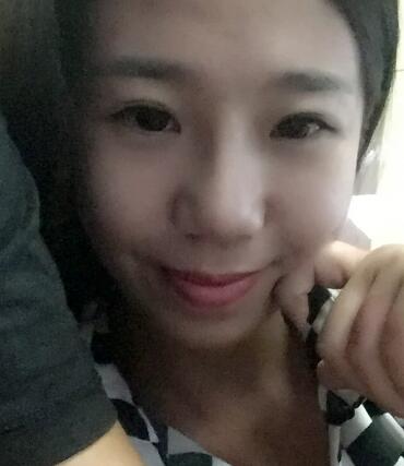 假體隆鼻術(shù)后注意事項(xiàng)和恢復(fù)過(guò)程圖分享