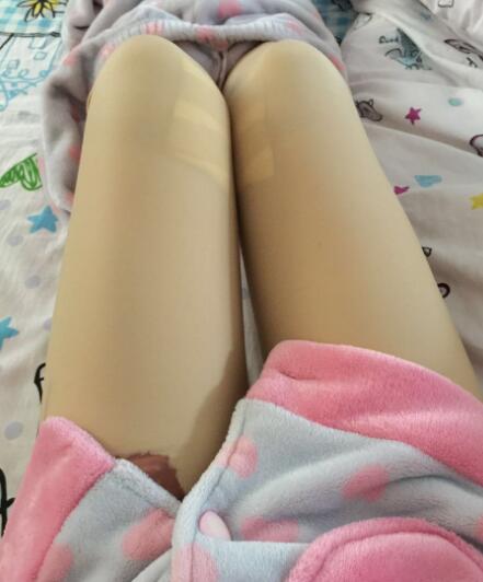 吸脂塑身醫(yī)院推薦歐蘭仁美醫(yī)院,吸脂瘦腿恢復圖分享