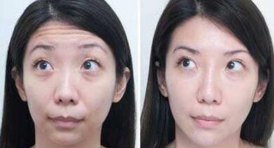 抬頭紋手術(shù)多少錢(qián)?去抬頭紋前后對(duì)比圖