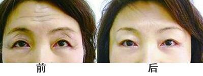 抬頭紋手術(shù)多少錢(qián)?去抬頭紋前后對(duì)比圖