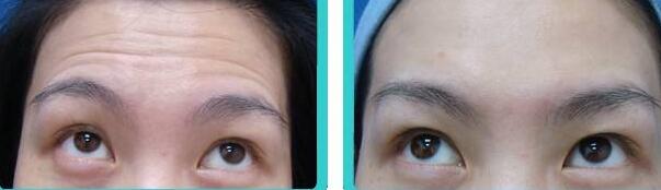 抬頭紋手術(shù)多少錢(qián)?去抬頭紋前后對(duì)比圖