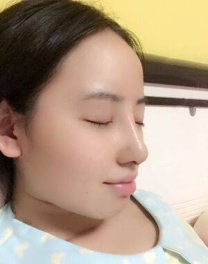 貴陽(yáng)美萊梁潔隆鼻整形兩個(gè)月果圖