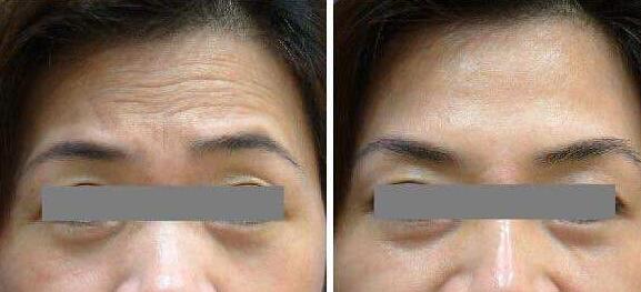 去抬頭紋前后對比圖，去抬頭紋手術(shù)多少錢？