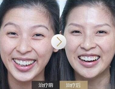 去抬頭紋前后對比圖，去抬頭紋手術(shù)多少錢？