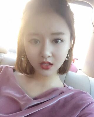 太原曹立銘面部吸脂瘦臉手術(shù)果圖