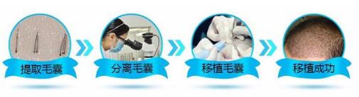 頭發(fā)移植需要多少錢？靠譜嗎？