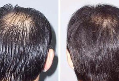 頭發(fā)移植需要多少錢？靠譜嗎？