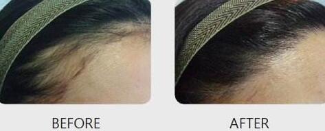 頭發(fā)移植需要多少錢？靠譜嗎？