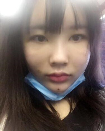 武漢美亞金國(guó)華醫(yī)生幫我做的自體脂肪全臉填充果恢復(fù)案例