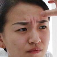 注射瘦臉去抬頭紋眉間紋恢復(fù)過程圖，真實(shí)案例分享