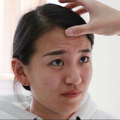 注射瘦臉去抬頭紋眉間紋恢復(fù)過程圖,真實案例分享