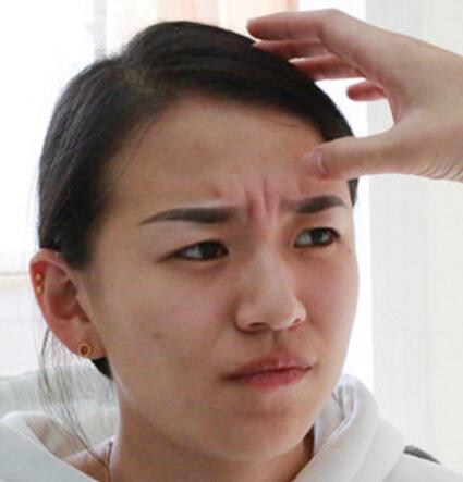 注射瘦臉去抬頭紋眉間紋恢復(fù)過程圖,真實案例分享