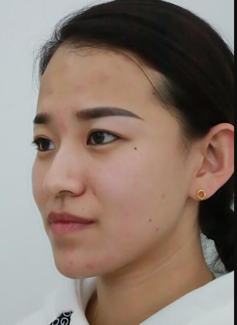 注射瘦臉去抬頭紋眉間紋恢復(fù)過程圖,真實案例分享