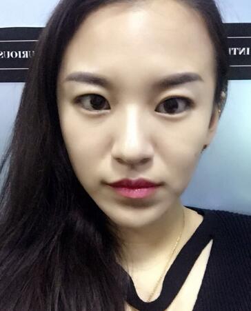 注射瘦臉去抬頭紋眉間紋恢復(fù)過程圖,真實案例分享