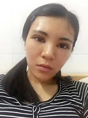 青?？等A馬晶醫(yī)生切開雙眼皮真實案例分享
