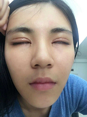 青?？等A馬晶醫(yī)生切開雙眼皮真實案例分享