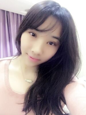 洛陽孔繁榮切開雙眼皮+開眼角手術(shù)恢復(fù)過程圖