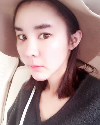 自體脂肪面部填充三個月果圖分享，減齡十歲