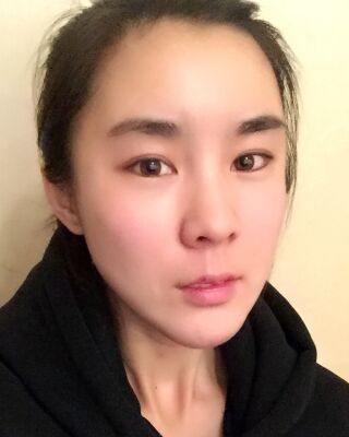 自體脂肪面部填充三個月果圖分享，減齡十歲