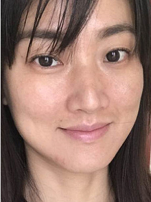 濟南愛容路傳燕醫(yī)生做的激光去黃褐斑，大家快來看看果如何