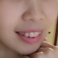 牙齒矯正的適宜年齡，多對(duì)比圖真實(shí)案例分享——成都格林口