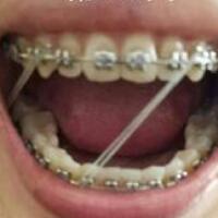 成人牙齒矯正費(fèi)用9800元——成都格林口腔醫(yī)院