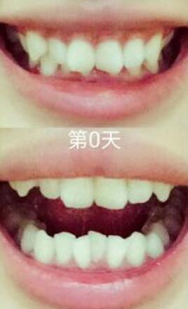 成人牙齒矯正費(fèi)用9800元——成都格林口腔醫(yī)院