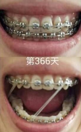 牙齒矯正前后對(duì)比圖,成人牙齒矯正費(fèi)用9800元——成都格林口腔醫(yī)院