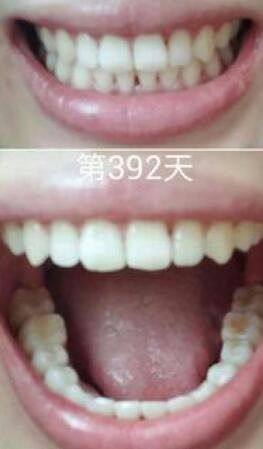 牙齒矯正前后對(duì)比圖,成人牙齒矯正費(fèi)用9800元——成都格林口腔醫(yī)院