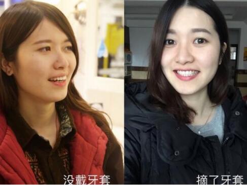 成都牙齒矯正前后對比圖分享——成都格林口腔
