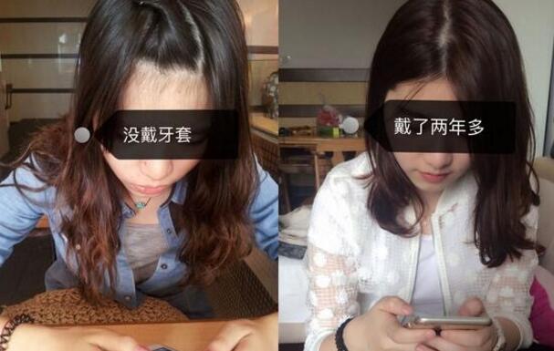 成都牙齒矯正前后對比圖分享——成都格林口腔