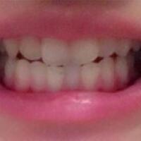 成都矯正牙齒案例分享——成都格林口腔醫(yī)院