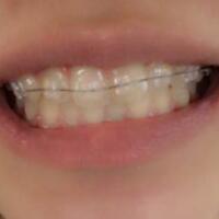 成都矯正牙齒案例分享——成都格林口腔醫(yī)院