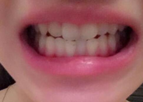 成都矯正牙齒案例分享——成都格林口腔醫(yī)院