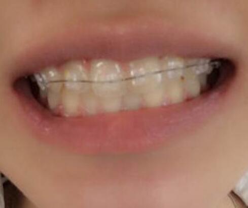 成都矯正牙齒案例分享——成都格林口腔醫(yī)院