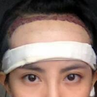 種頭發(fā)有用嗎？種植頭發(fā)恢復過程真實案例——南京明基醫(yī)院