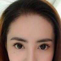 種頭發(fā)有用嗎？種植頭發(fā)恢復過程真實案例——南京明基醫(yī)院